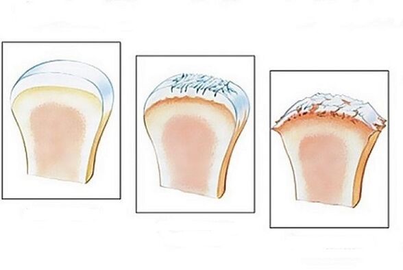 joint damage at different stages of arthrosis development