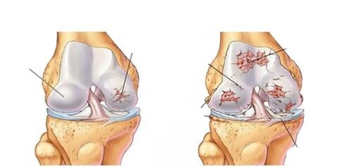 deformity of knee arthrosis