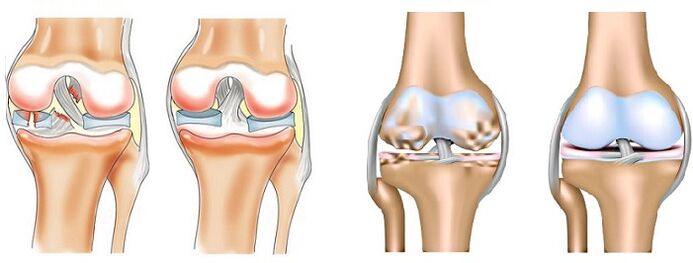 The difference between arthritis (left) and arthrosis (right) of the joint