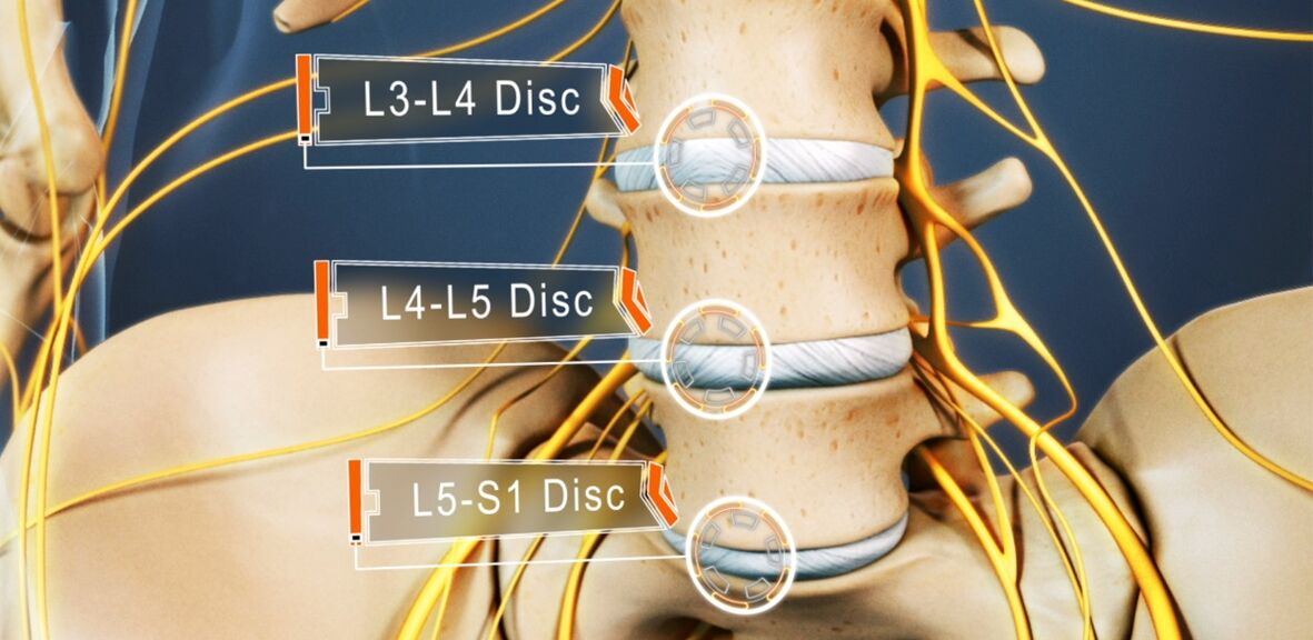 Lumbar spinal disc, most often affected in osteochondrosis