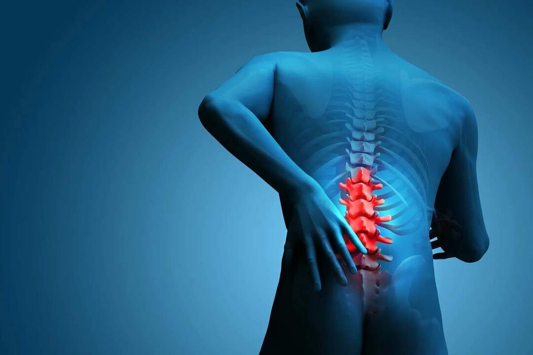 The main symptom of lumbar spine osteochondrosis is lower back pain. 