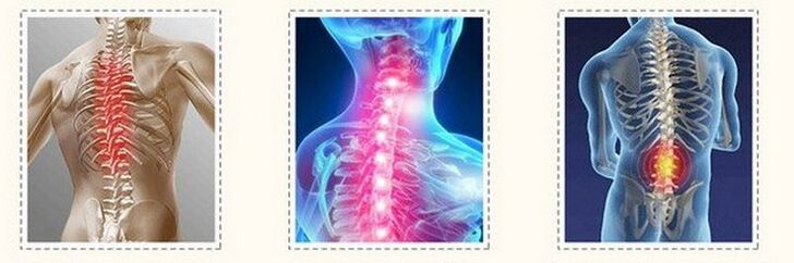 different spinal osteochondrosis