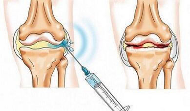 Knee joint restrictions for arthrosis