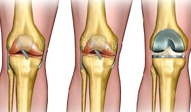 The developmental stage of the arthrosis of the knee joint