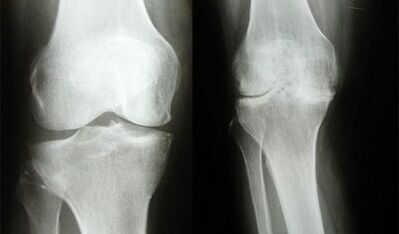 The method of diagnosis of the knee