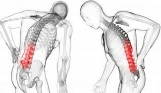 Intervertebral hernia - complications with osteochondrosis