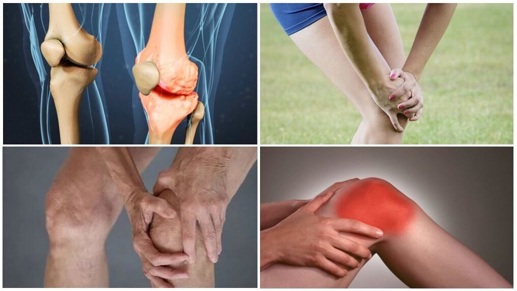 Stage of arthrosis