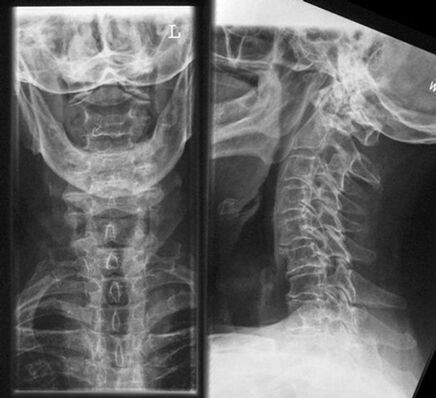 Cervical X -ray - a method of diagnosis of osteochondrosis