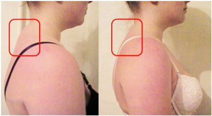 The formation of a muscle roller with cervical osteochondrosis