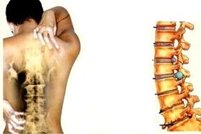 back pain at different levels of the development of cervical osteochondrosis