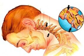 nerves pinching in the spine with cervical osteochondrosis