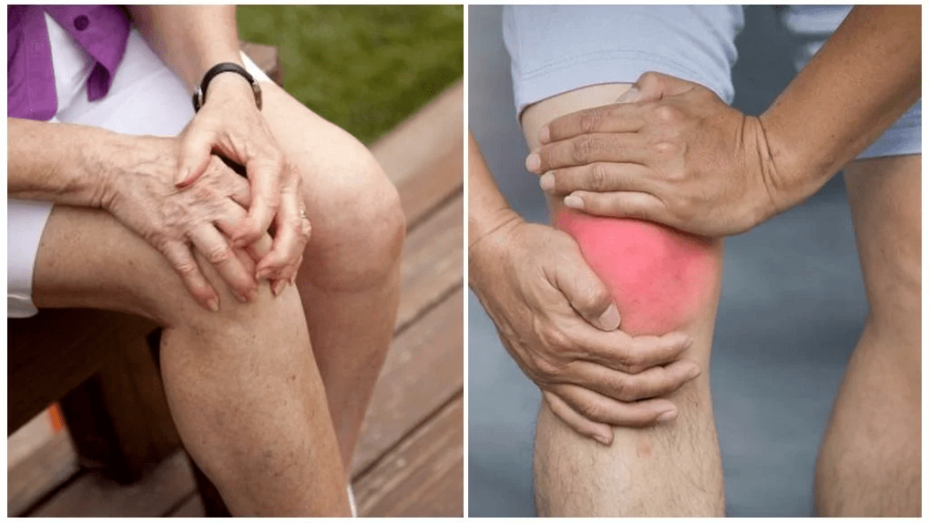 arthrosis treatment