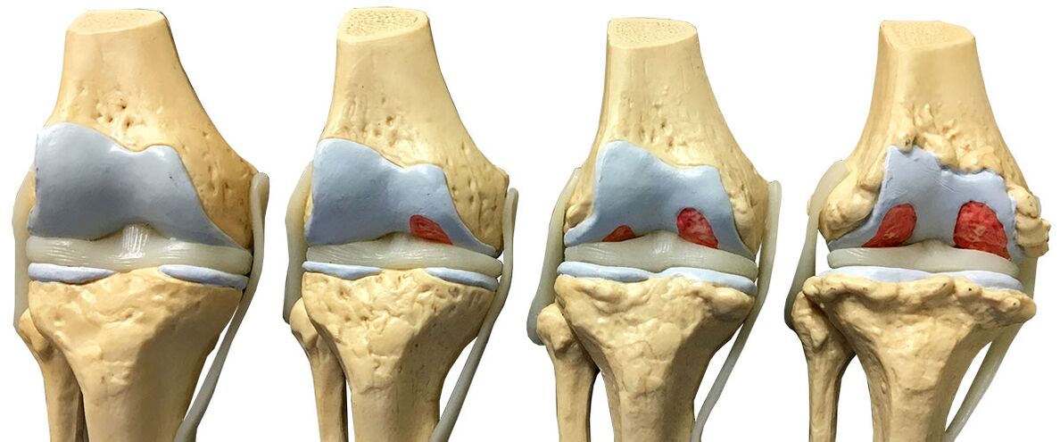 stage of arthrosis